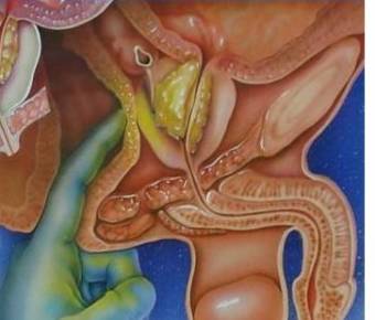 masaje  prostatico  dura mas  da mas placer  si se te baja o te vienmes rapido aqui esta la solucion
