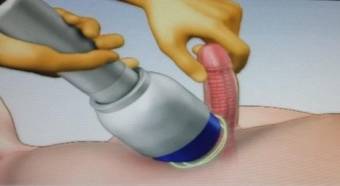 masaje  prostatico  no te  vengas rapido dura  mas  gel bach