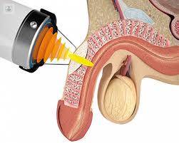 MASAJE  PROSTATICO   RESULTADOS  INMEDIATOS  EVITA FLASIDES Y RAPIDES